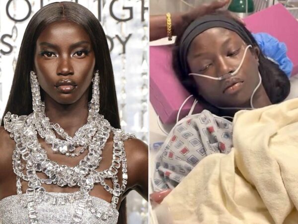 Supermodel Anok Yai Opens Up About Being Diagnosed With A Congenital Defect