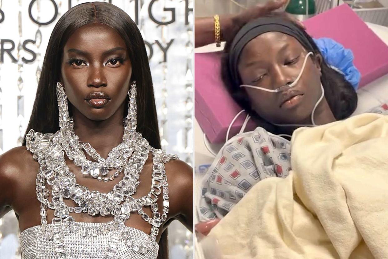 Supermodel Anok Yai Opens Up About Being Diagnosed With A Congenital Defect